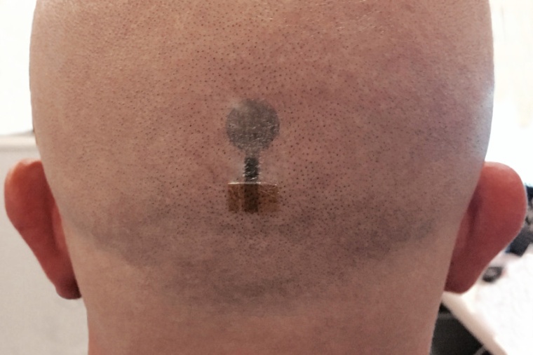 Abb.: Die Zuverlässigkeit und Genauigkeit der Tattoo-Elektroden wurde...